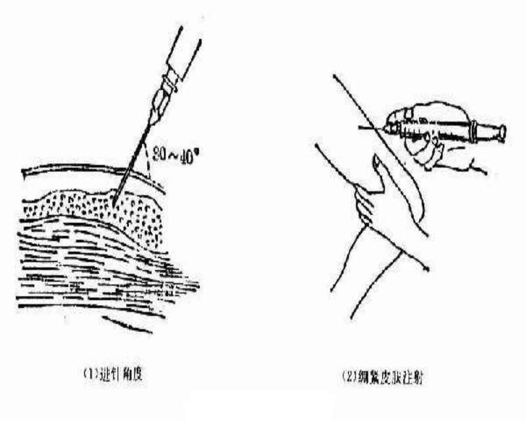 活力新篇章：全新肌肉注射技术革新